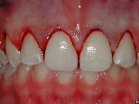 Diş Eti Çekilmesi Nasıl Önlenir?